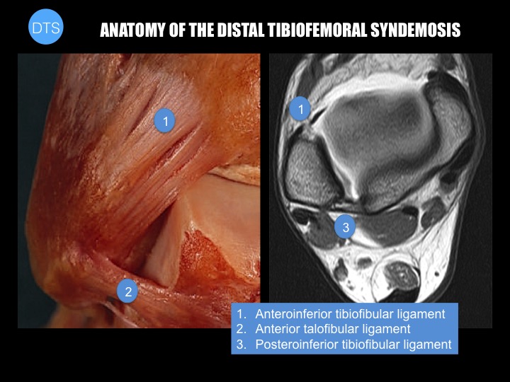 Figure 3 for case High ankle sprain Acute complete rupture of the syndemotic ligament complex